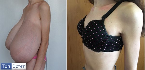 уменьшение груди фото до и после